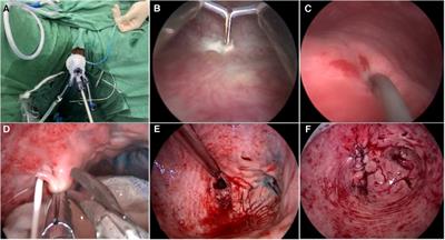 Minimally invasive transvaginal single-port laparoscopic vesicovaginal fistula repair: a case report and the point of this technique